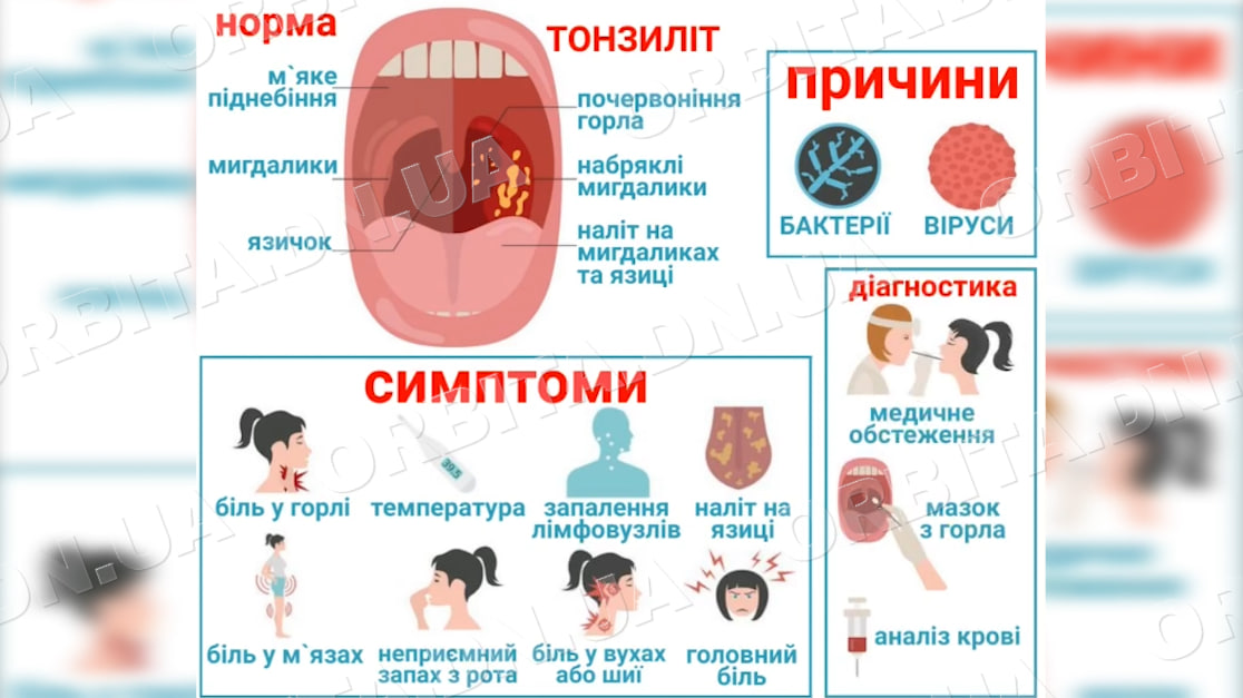 Підступний мікроб. Як побороти хронічний тонзиліт