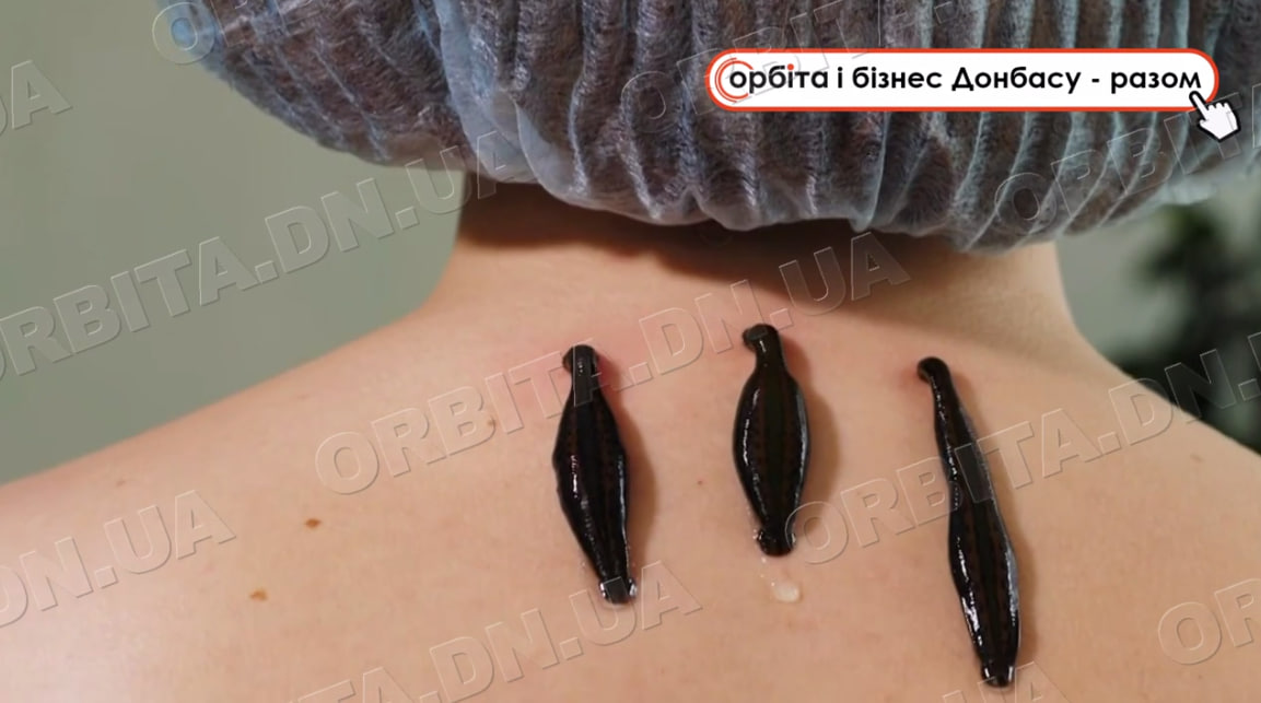 П’явки для здоров’я: покровський лікар практикує гірудотерапію у Білій Церкві