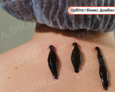 П’явки для здоров’я: покровський лікар практикує гірудотерапію у Білій Церкві