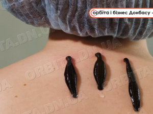 П’явки для здоров’я: покровський лікар практикує гірудотерапію у Білій Церкві